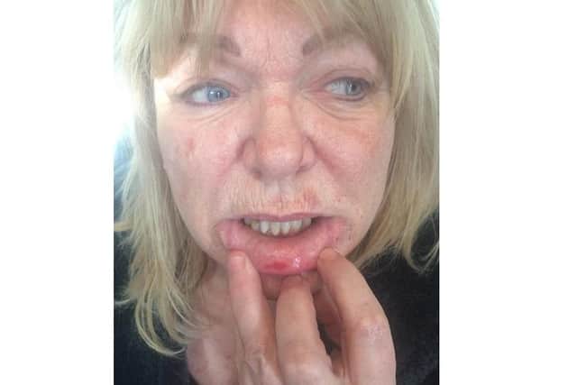 Linda Veck, 63, suffered cuts to the inside of her mouth and bruises to her face