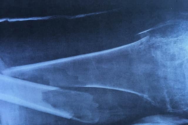 An X-ray shows the fracture to Gary Lewis's leg SUS-200717-084759001