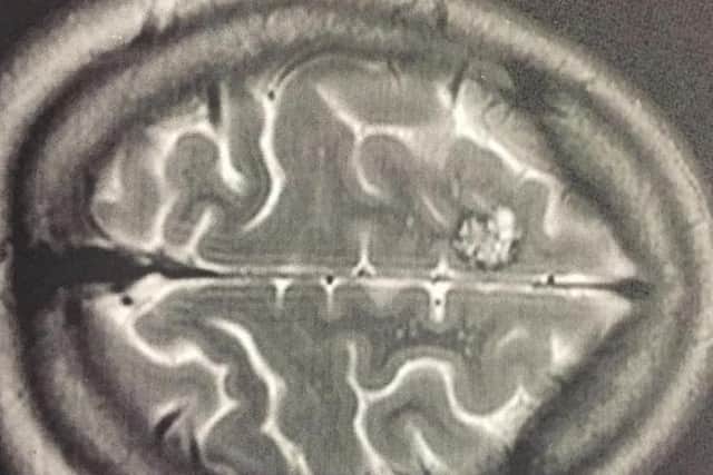 Simona Stankovska, 32, of Priory Road, Rustington, has been given the British Citizen Award Medal of Honour for setting up The Cavernoma Society. Her brain scan, showing the cavernoma
