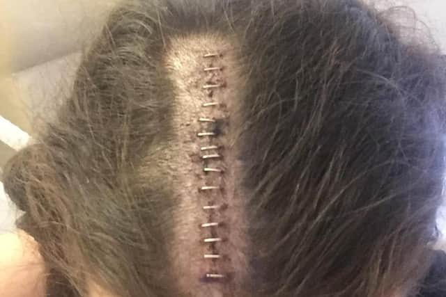 Simona Stankovska, 32, of Priory Road, Rustington, has been given the British Citizen Award Medal of Honour for setting up The Cavernoma Society. Pictured: her scar following the operation