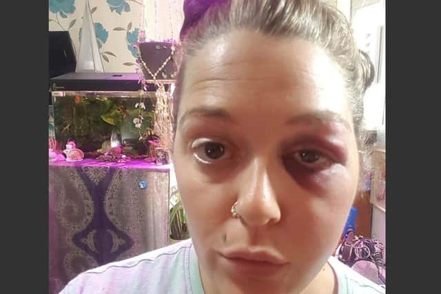 Kay Early was left with a black eye, cuts and bruises after being attacked by a stranger in Alexandra Park SUS-210316-152655001