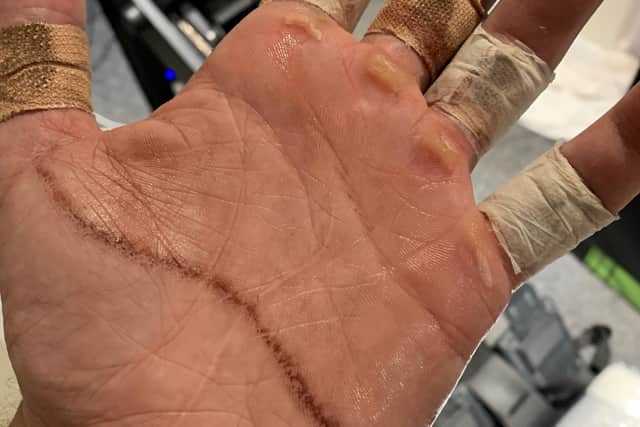 Harry's hand after the 24-hour challenge