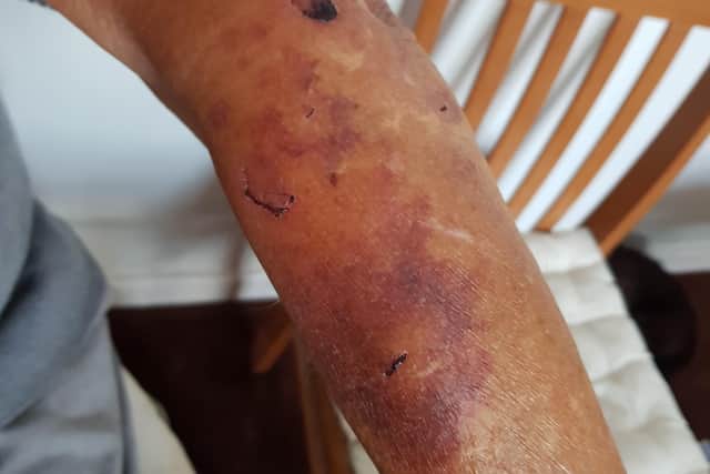 The injury to Anthony Richardson's arm following the incident with the bike on Eastbourne seafront SUS-211019-122648001
