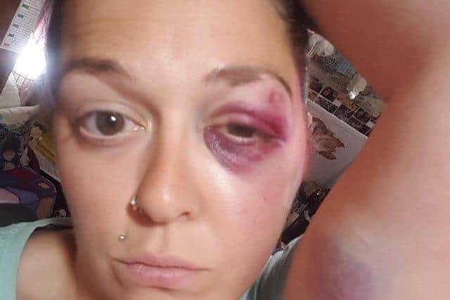 Kay Early was left with a black eye, cuts and bruises after being attacked by a stranger in Alexandra Park SUS-210316-152705001