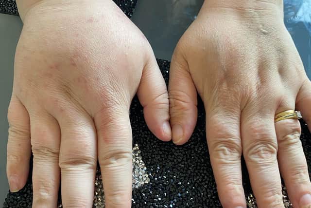Swelling in Heather's hand was misdiagnosed as an infection