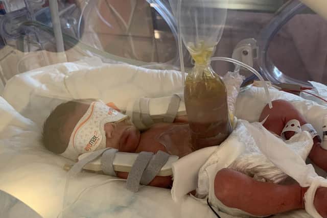 Baby Vienna had to undergo life saving surgery in the neonatal intensive care unit at Southampton Hosptial after being born with a congential condition.