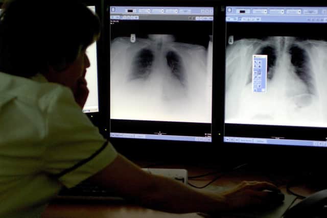 Citizens Advice in West Sussex will hold a lung cancer awareness event on Zoom next week. Picture by Rui Vieira/PA Archive/PA Images