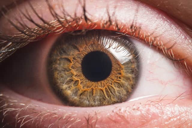 Corneal blindness often comes about as a result of trauma like a scratch to the eyeball from a piece of debris.