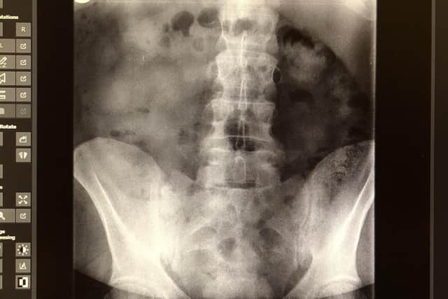 The x-ray of Mark Dunford's lower spine