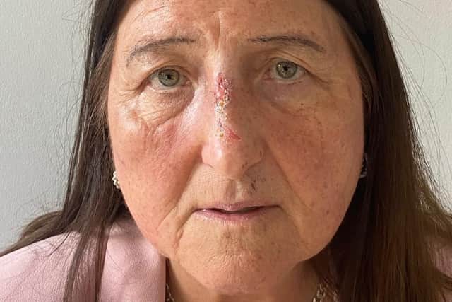 Eileen Robinson, 68, said she suffered facial injuries after a fall in Wivelsfield Green on Friday, May 19