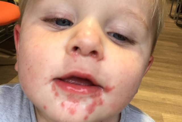 Little Tommy Muggeridge was covered in a nasty rash but his mum couldn't get a GP appointment
