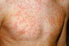 Measles. Picture from ESCC