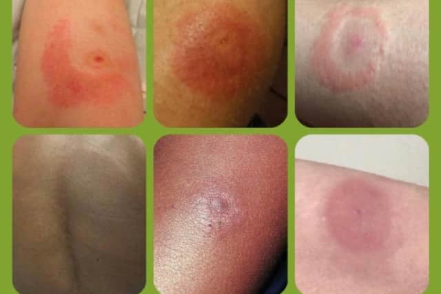 The EM rash. Picture: Lyme Disease UK