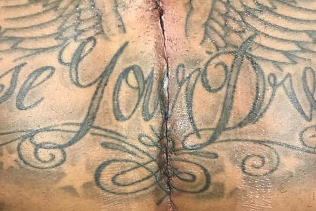 Connor Goldson's scar after heart surgery in 2017 | Picture: submitted