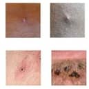 Images of monkeypox from the government website
