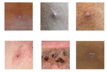 Images of monkeypox from the government website