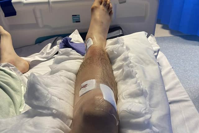 Tony Halsey shared this picture of his broken leg from his hospital bed