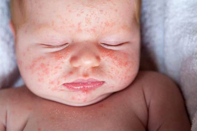 Scarlet Fever rash. Photo: NHS