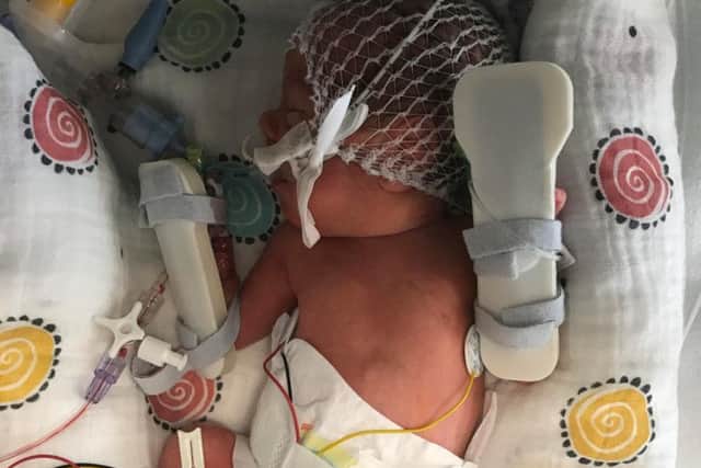 Lana was born three months early and needed life-saving heart surgery when she was still tiny