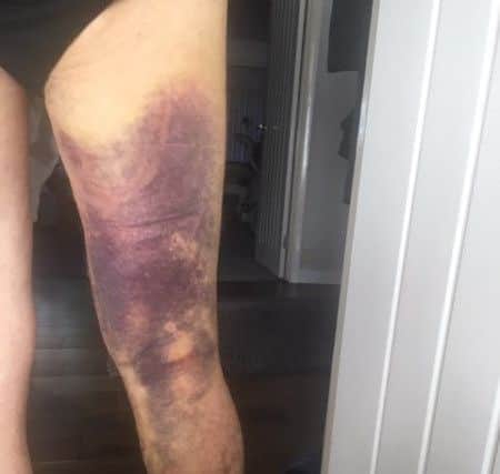 The extent of Stan's bruising after the collision