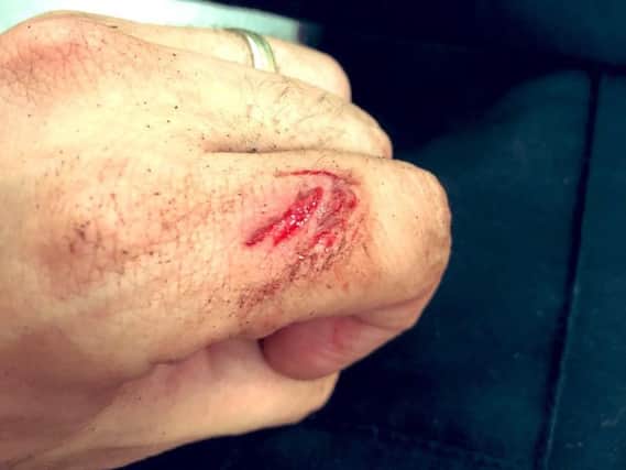 Special Constable Pete Jennings posted a photo of the bite he received. Pictures: Sussex Police/SC Jennings