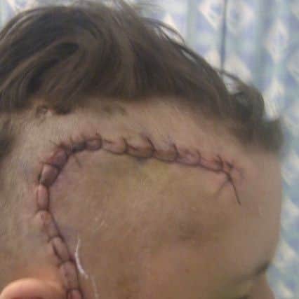 Anna's scar left after the brain surgery for her epilepsy