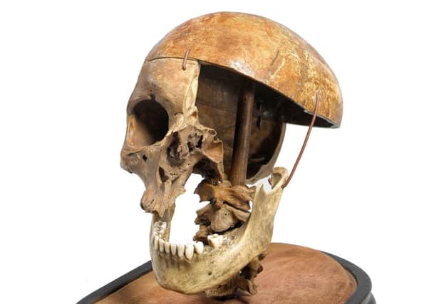 A 19th century felon skull sold by Summers Place Auctions in Billingshurst