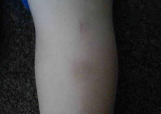 The bruise left on Theo's leg from the alleged assault