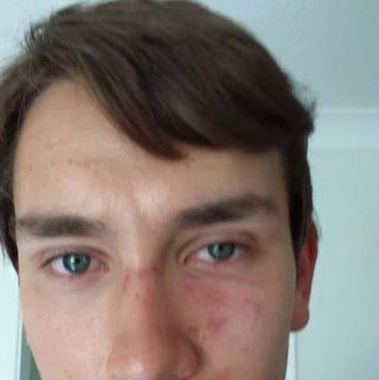 Thomas Attwater after he was punched at Butlin's. Contributed picture Y3OwG3VZMKwcSkvP8TI3