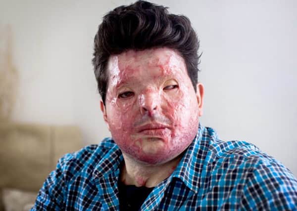 Andreas Christopheros who was was left scarred for life after a man hurled acid in his face Photo by James Dadzitis / SWNS.com