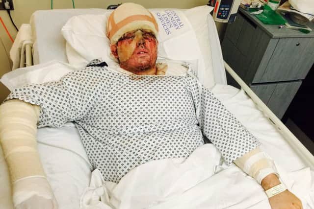 Andreas Christopherospictured in hospital recovering from a acid attack SWNS.com