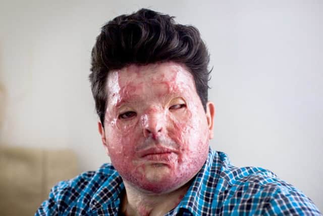 Andreas Christopheroswho was was left scarred for life after a man hurled acid in his face Photo by James Dadzitis / SWNS.com