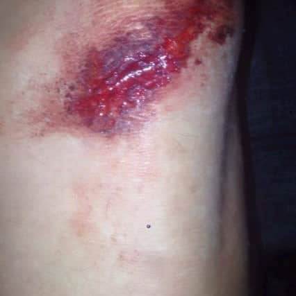 The biker's knee after the crash
