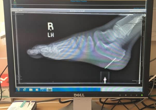 X-ray showing the metal embedded in the child's foot
