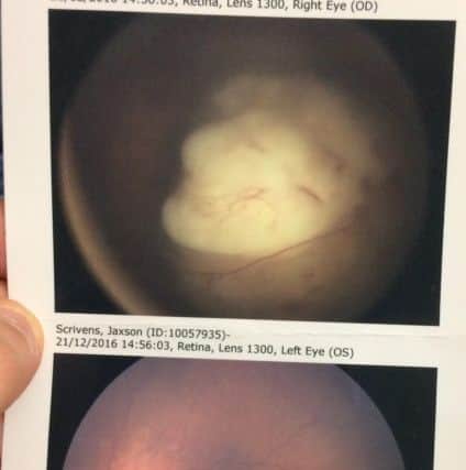 A scan showing the tumour in his right eye. Owen and Emily are desperate to raise awareness so families can catch retinoblastoma early