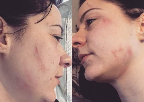 The injuries sustained after the attack. Picture: lspraggan/Instagram SUS-170319-101834001