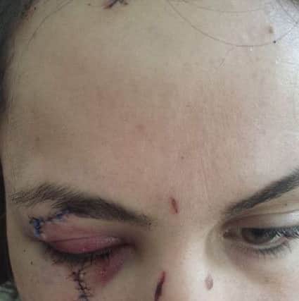 Faye Sharpe, 24, who was attacked by Karl Gates, has been left with permanent scars to her face