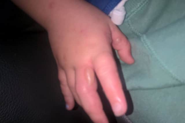 Tom's hands came up with blisters and swelling
