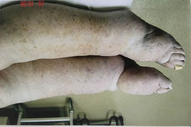 The legs of a patient born with lymphoedema