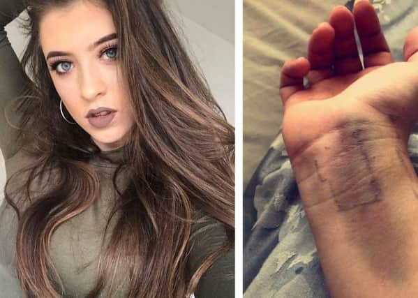 ChlÃ¶e Osborne-Shaw (left) had to have injections in her wrist (right) to help tackle a severe allergic reaction 0mCvICQKgdp3-tMk4un5